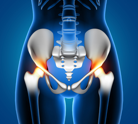 Hip Replacement Surgery in Turkey | Expert Care for Hip Replacement ...